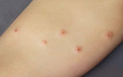 Do Bed Bug Bites Look Different from Other Insect Bites?